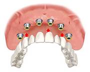 Perfect Smile nobel guide clinical steps
